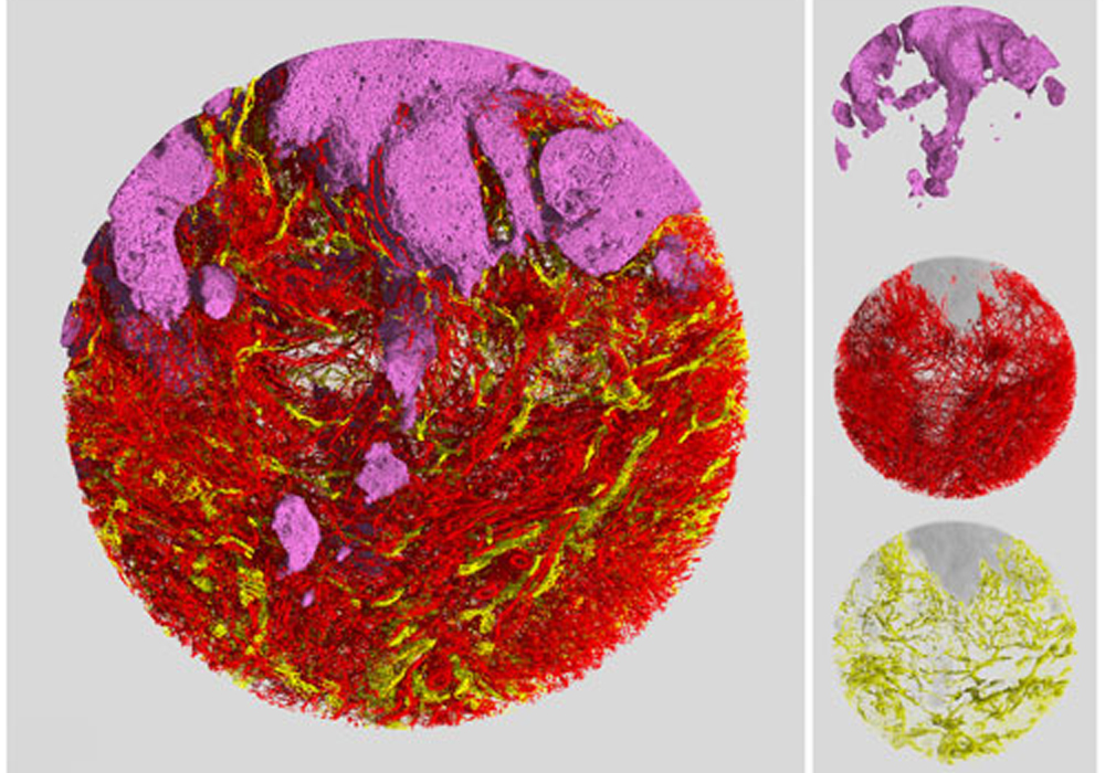 Work A2-2 癌胞巣周囲の血管・リンパ管網