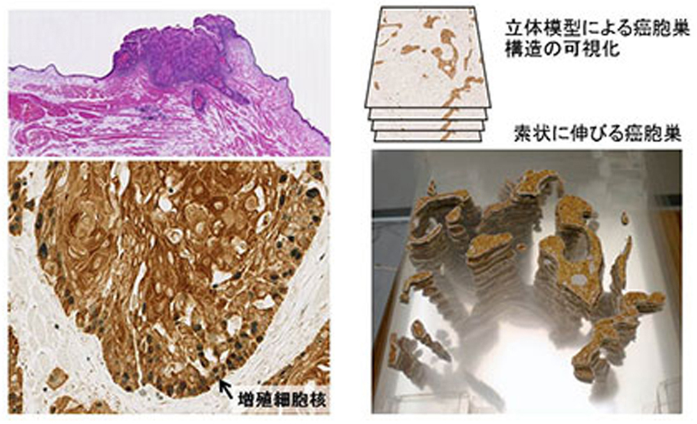 Work B3-h21 扁平上皮癌の病理組織学的特徴