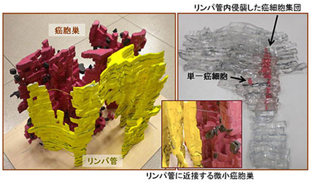 Work B3-h23 舌扁平上皮癌のリンパ管侵襲