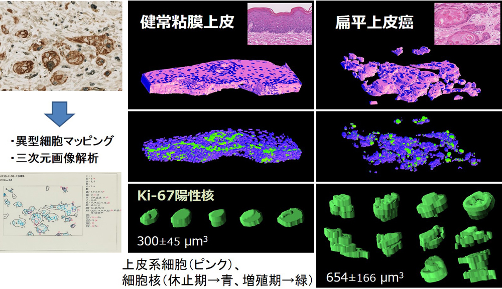 Work B3-h28 舌扁平上皮癌における細胞増殖活性